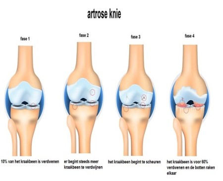 artrose knie1.jpg